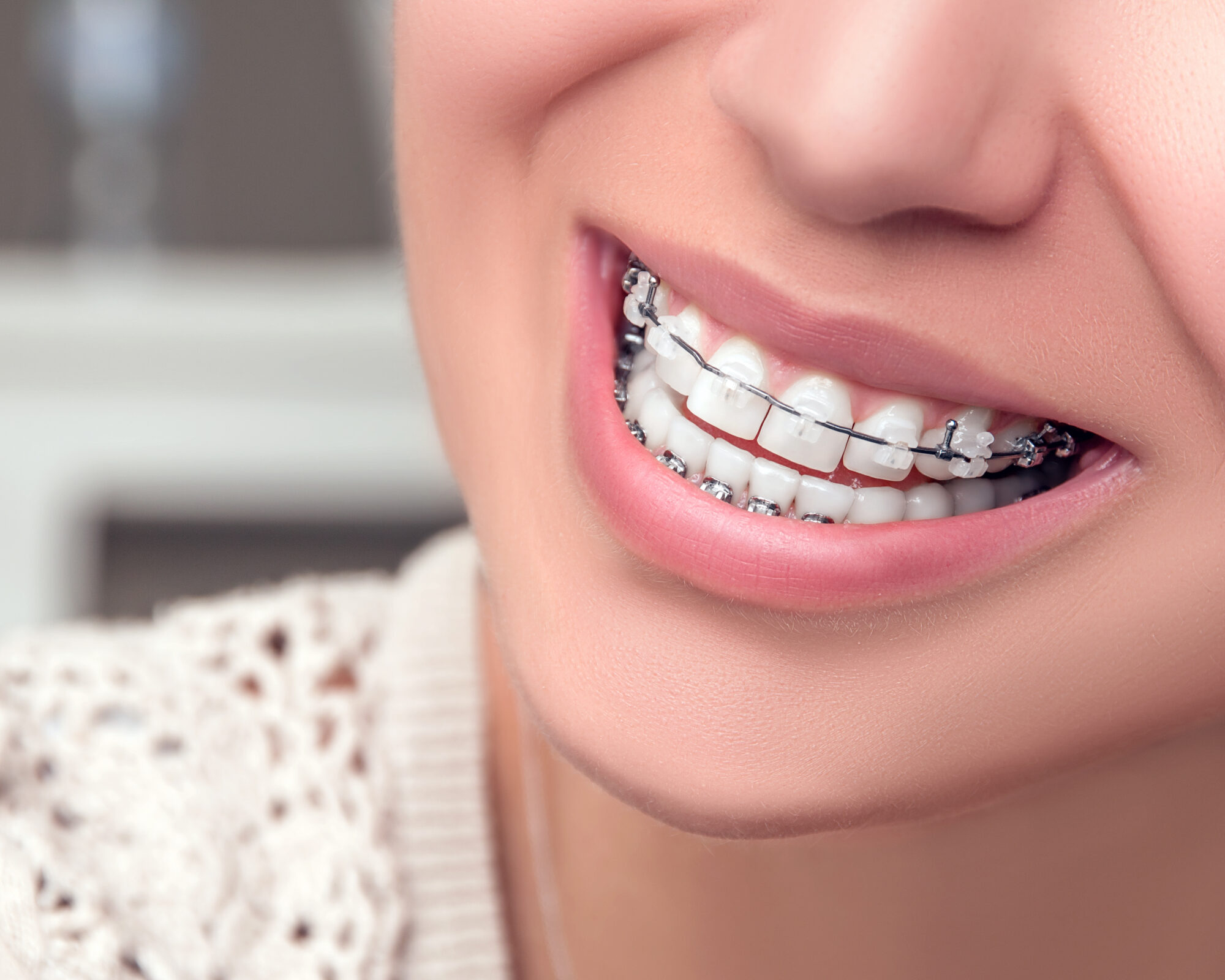 braces in orlando