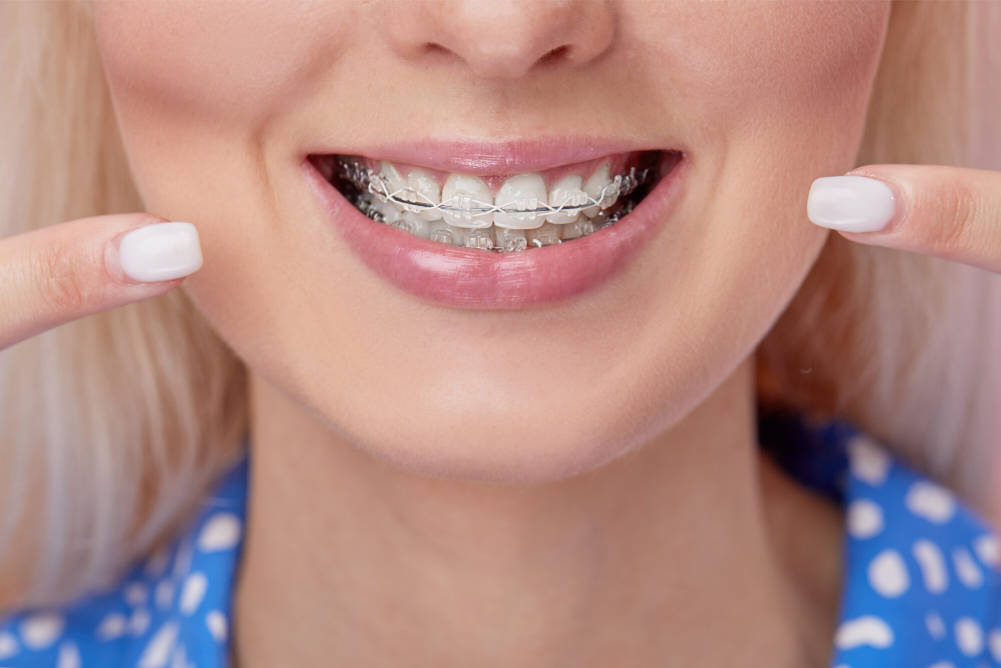 invisalign orlando